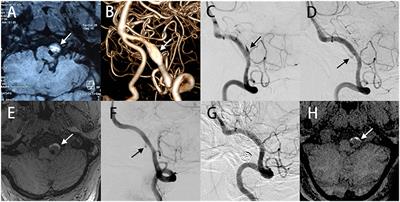 Case Report: De novo Vertebral Artery Dissection After Intravascular Stenting of the Contralateral Unruptured Vertebral Artery Aneurysm